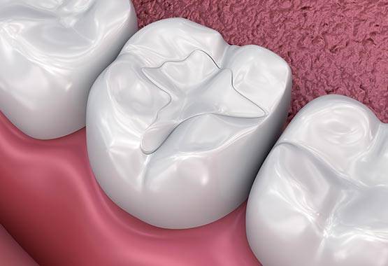 Ceramic fillings