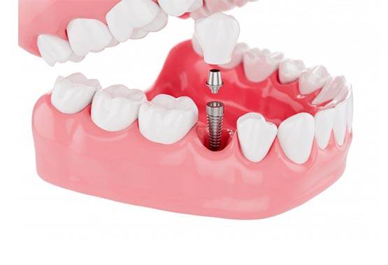 Implantology