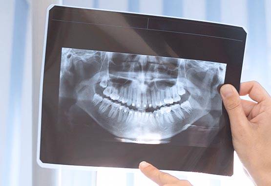 Dental volume tomography